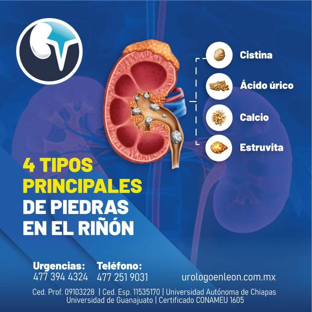 4 tipos principales de piedras en los riñones